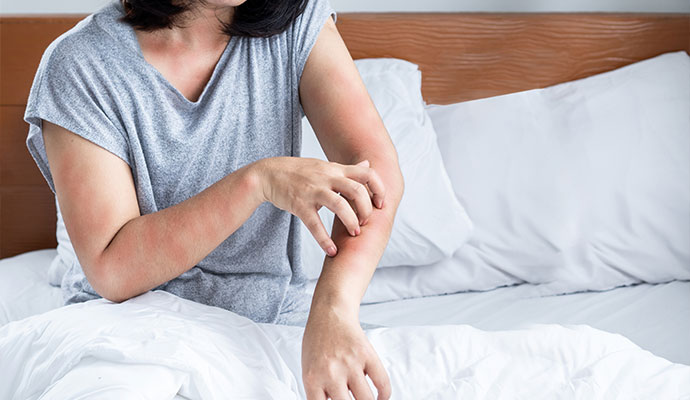 A woman scratching the skin rash on her arm