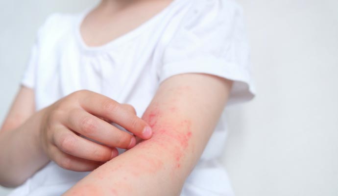 Person affected by allergy